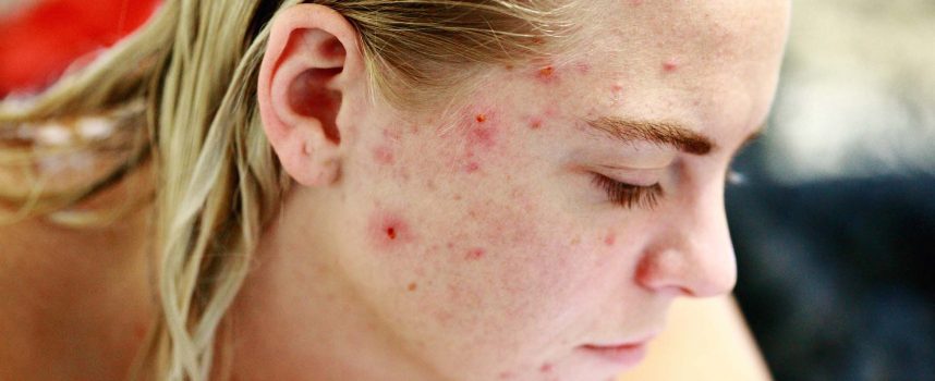 Blizny po trądziku – jak się ich pozbyć?