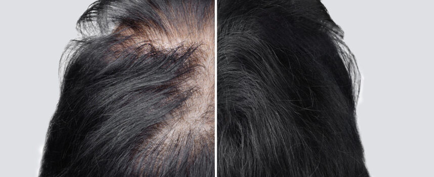 Jak radzić sobie z łysieniem androgenowym?